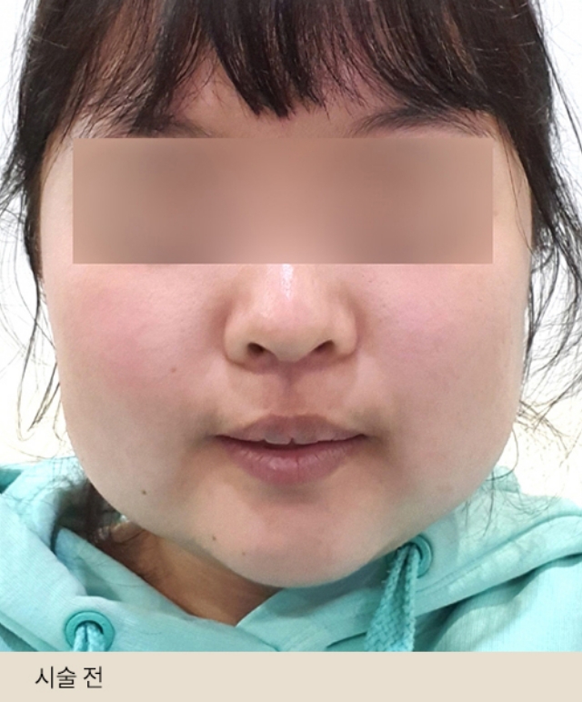 Body Cut Injection – Lower Body