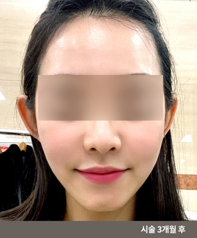 Non-Surgical Fat Graft Removal