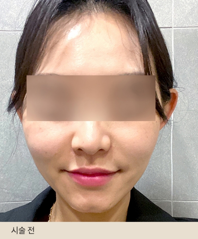 Cell Regeneration Injection (Stem Cell Injection)