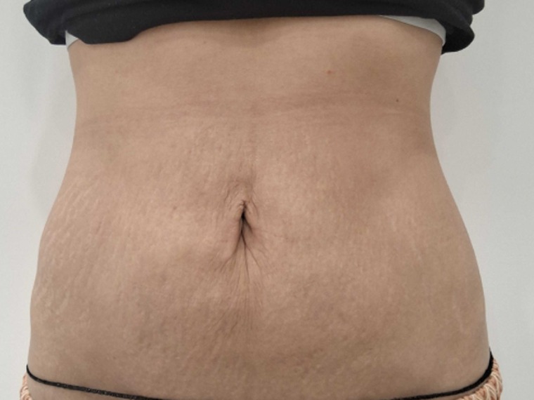 Renuvion · abdomen after treatment at HOMMAGE Clinic